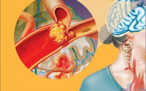 Giảm tai biến phình mạch não nhờ kỹ thuật mới