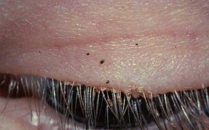 Bé 6 tuổi bị rận mu tấn công