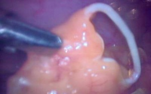 Vòng tránh thai 'vào nhầm' ổ bụng