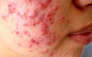 Nguy cơ ung thư vì kem tẩy trắng da cấp tốc