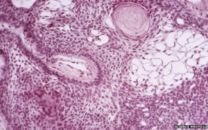 Ứng dụng tế bào gốc chữa ung thư não