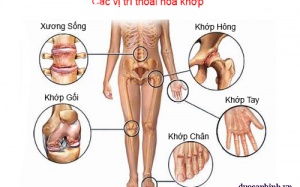 Chữa thoái hóa khớp bằng cách nào?