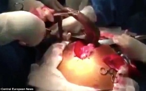 Phẫu thuật lấy cá sống dài 60cm trong bụng