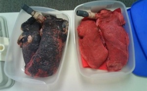 Phổi đen xì do hít khí than tổ ong