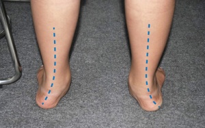 Điều trị tật bàn chân bẹt ở trẻ nhỏ