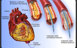 Cần làm gì sau khi đặt ống stent nong mạch vành?