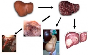 Phòng ngừa ung thư gan: Lời khuyên dành cho bạn