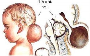 Thoát vị màng não tủy: Cần can thiệp sớm