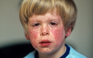 Rubella - Có thể bạn chưa biết?