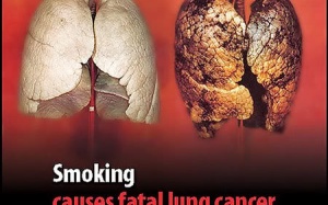 Mỗi năm 1,5 triệu người chết vì ung thư phổi