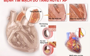 Tăng huyết áp: Âm thầm mà nguy hiểm
