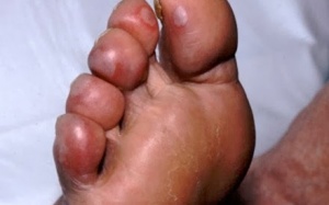 Mẹo hay phòng cước chân tay mùa lạnh