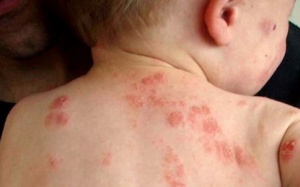 Cách điều trị chàm da mỡ