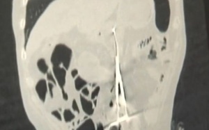 “Bỏ quên” kéo trong bụng người bệnh suốt 12 năm