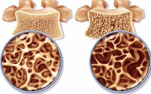 Chống loãng xương không phải chỉ cần Calci