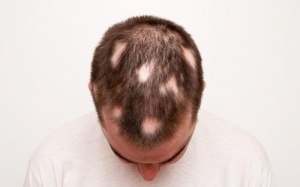 Cải thiện hệ miễn dịch – giải pháp chữa hói hiệu quả