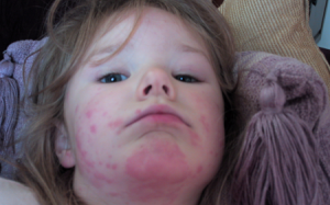 Vì sao phụ nữ dễ bị sốc phản vệ hơn nam giới?