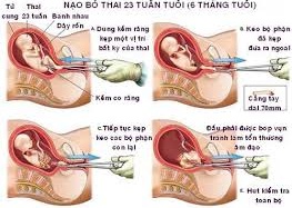 Thai phụ 8 tháng  vẫn nạo hút được?