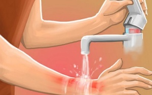 Có nên rắc bột kháng sinh lên vết bỏng?