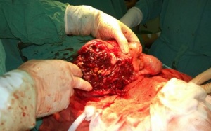 Phẫu thuật thành công cho bệnh nhân có khối u mạc treo phức tạp