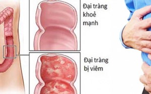Viêm đại tràng: Điều trị muộn là thiệt