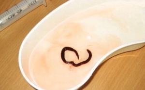 Kinh hãi tử vong vì bị giun 'khổng lồ' ăn thận