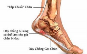 Cách giảm đau, viêm dây chằng bàn chân (P2)