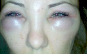 Mặt tê liệt vì tiêm boxtox Trung Quốc