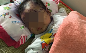 2 bệnh nhi nguy kịch vì nhiễm thủy đậu lây từ mẹ