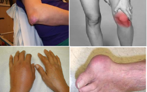 Giảm cơn đau do gout trong mùa đông bằng cách nào?