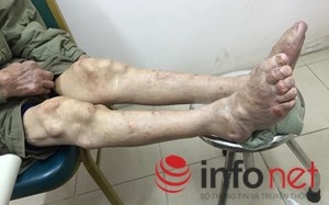 Suy thận vì điều trị gout ở phòng khám Đông y Trung Quốc