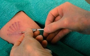 ​Thiết bị ngừa thai hiệu lực lâu hơn mong đợi