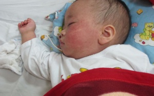 Hà Nội tăng cường giám sát sởi