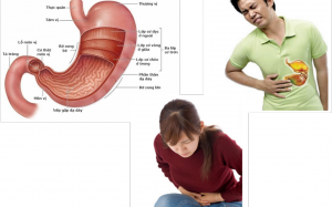 Giảm viêm loét dạ dày - tá tràng bằng cách nào?