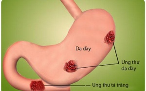 Nhận biết sớm ung thư đường tiêu hóa