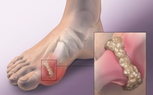 Người bệnh gout khó mắc Alzheimer?