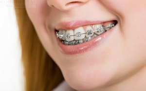 Những điều cần lưu ý khi niềng răng
