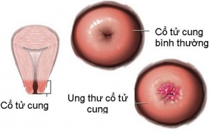 Hơn 2.000 phụ nữ Việt tử vong mỗi năm vì ung thư cổ tử cung