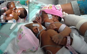 Cặp song sinh cùng chia sẻ một trái tim