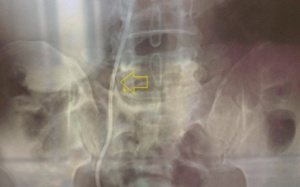 Ông cụ bỏ quên ống thông trong người 4 năm