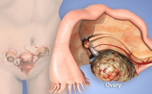 Nên hay không cắt buồng trứng dự phòng ung thư?