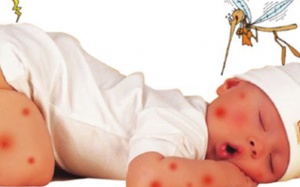 Lý do khiến bạn bị muỗi đốt nhiều hơn người khác?