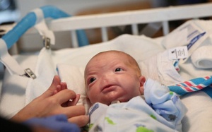 Sức sống kỳ diệu của em bé không mũi