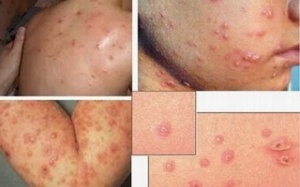 Cảnh báo bệnh thủy đậu đang vào mùa