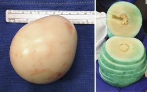 Khối u to như quả trứng ngỗng trong bàng quang