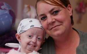 ​Cô bé mắc chứng lão hóa sớm qua đời ở tuổi 17