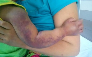 Bé 2 tuổi có nguy cơ mất cánh tay do rắn độc cắn