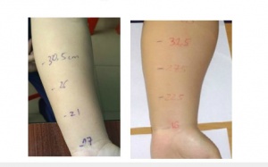 Lần đầu ghép hạch bạch huyết chữa ung thư vú thành công