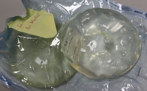 Ngực tách làm đôi vì nâng cấp bằng túi ngực giả