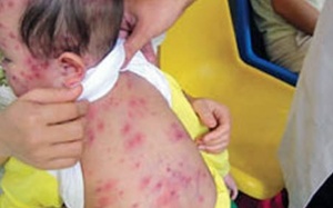 Chưa xuất hiện bệnh nhi sởi, rubella; lác đác ca thuỷ đậu